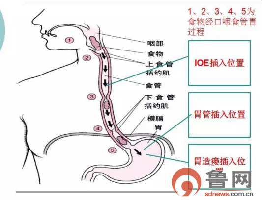 菏泽市牡丹人民医院成功开展ioe技术让吞咽障碍患者告别鼻胃管