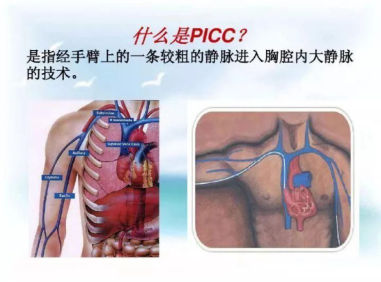 菏泽曹县中医院成功开展升级版b超引导下改良塞丁格picc置管术