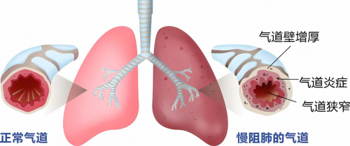 补肺丸被列入《慢<span class=