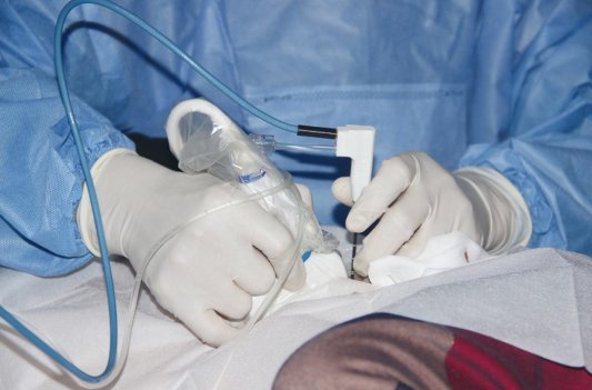 超声引导下穿刺