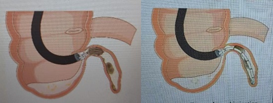 EDAT新技术:不开刀治疗阑尾炎及阑尾粪石,开启微创治疗新篇章