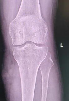 外伤拍完X线片后,为什么医生还会建议患者查CT、MR