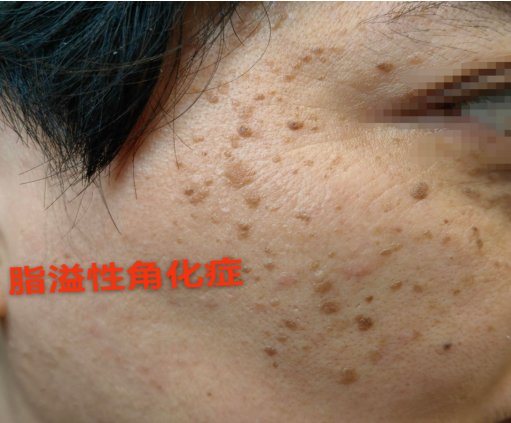 菏泽市创伤医院(市六院)皮肤科:二氧化碳激光技术精准治疗脂溢性角化症(老年斑)