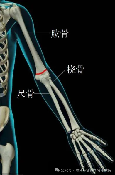 菏泽市创伤医院(市六院)微创治疗儿童肱骨髁上骨折