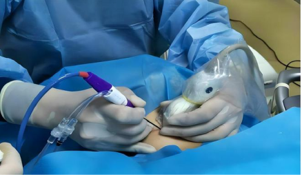 【名术天工集】济南市中西医结合医院:告别“一刀切”,留住颈间美丽——甲状腺微波消融术为您的健康与美观护航