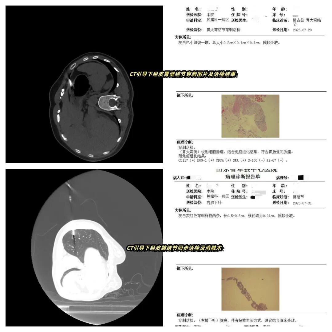 开拓创新,再破“禁区”——单县中心医院完成高难度CT引导下经皮胃壁穿刺联合肺结节同步活检消融术