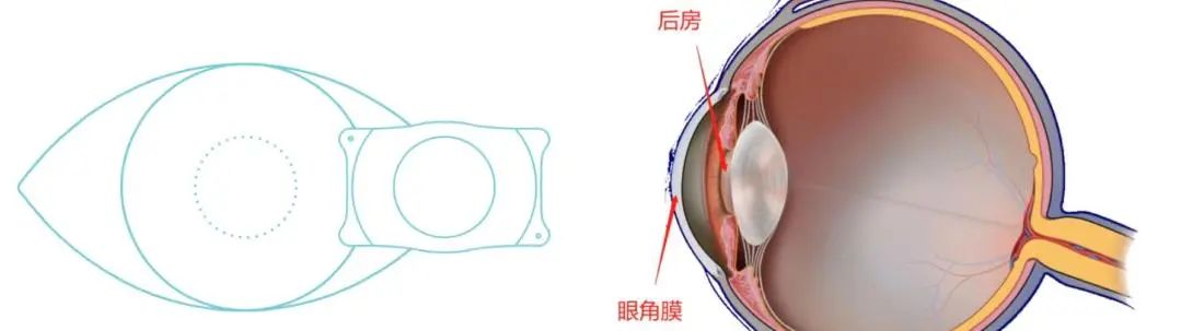 尖峰眼科提示:近视手术能摆脱哪些困境?