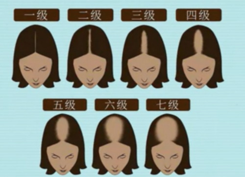 步长荣发:长期脱发困扰人群的新希望