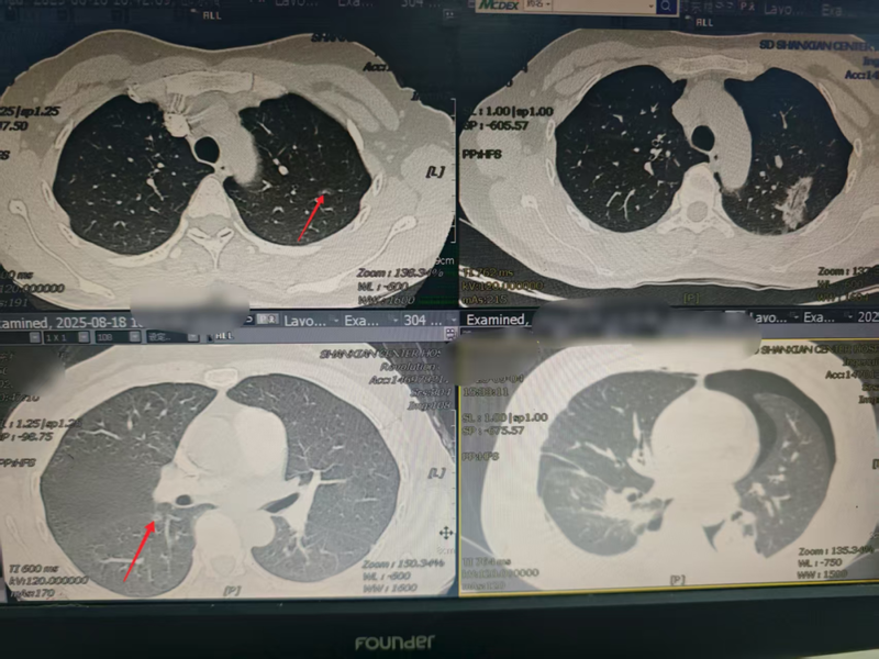 精准施良策,仁心解顽疾——单县中心医院心胸外科成功为双侧肺部多发结节患者行“右肺下叶背段切除+左肺上叶结节微波消融术”