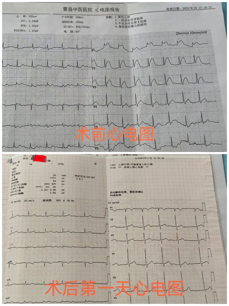 争分夺秒,极速救“心” 曹县中医医院胸痛中心一小时内成功救治高龄心梗患者