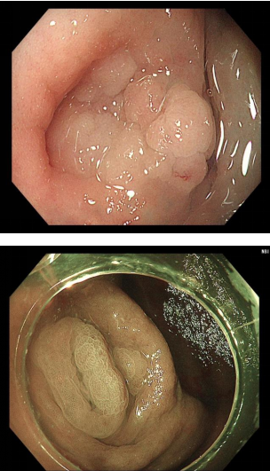 国庆坚守“医”线,内镜微创再突破 ——临沂市中医医院成功实施首例结肠镜下阑尾切除术
