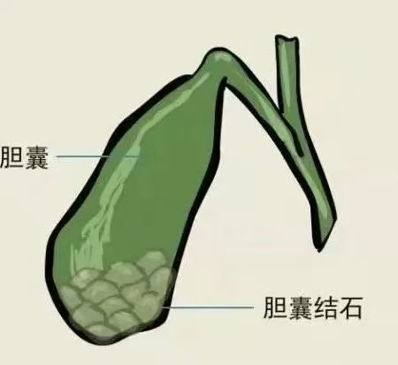 小小“石头”藏隐患,正确诊疗是关键!——关于胆石症的二三事