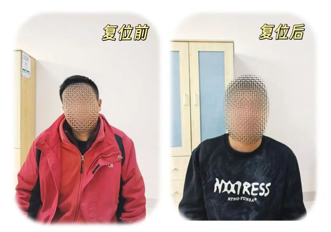 妙手扶正“生命枢纽”:济南南郊医院骨科门诊李守斌主任巧解寰枢椎脱位难题