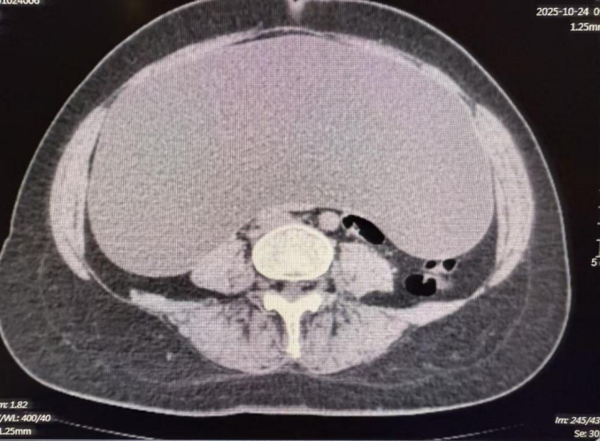 济南南郊医院:腹腔镜下腹腔巨大囊肿切除术成功 彰显多学科协作实力