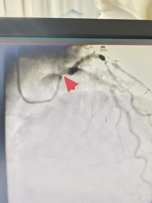 96岁“心”挑战!青岛西海岸第二医院心脏诊疗中心成功为超高龄患者实施高危介入手术