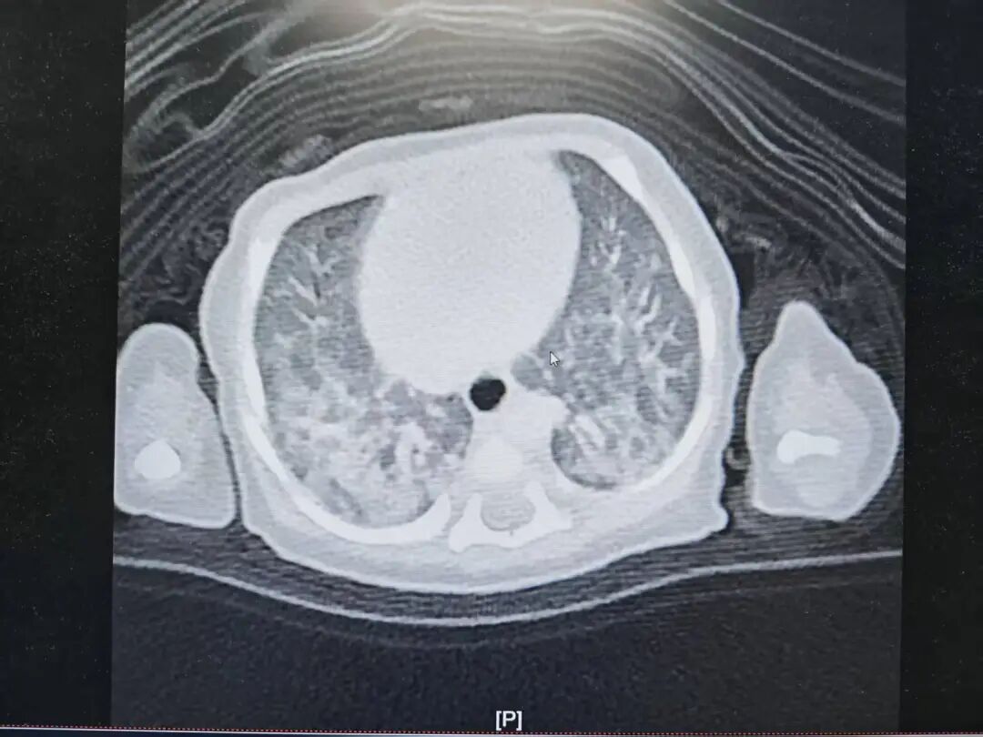 新生宝宝胎粪吸入,别怕!北大人民青岛医院NICU多学科联手守护生命第一口呼吸