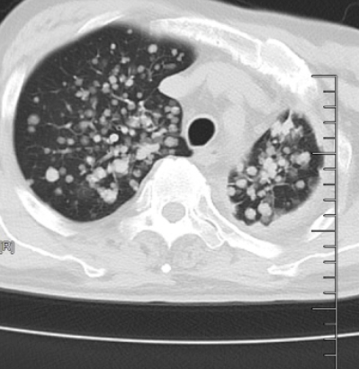 IVB期肺腺癌转移,脑内布满密密麻麻转移瘤!北大人民青岛医院肿瘤科帮七旬老人绝地求生!