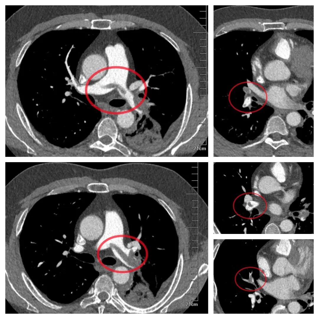 小伙因“感冒”就医,医生敏锐识破致命肺栓塞!精准介入取栓碎栓,成功化解“夺命危机”