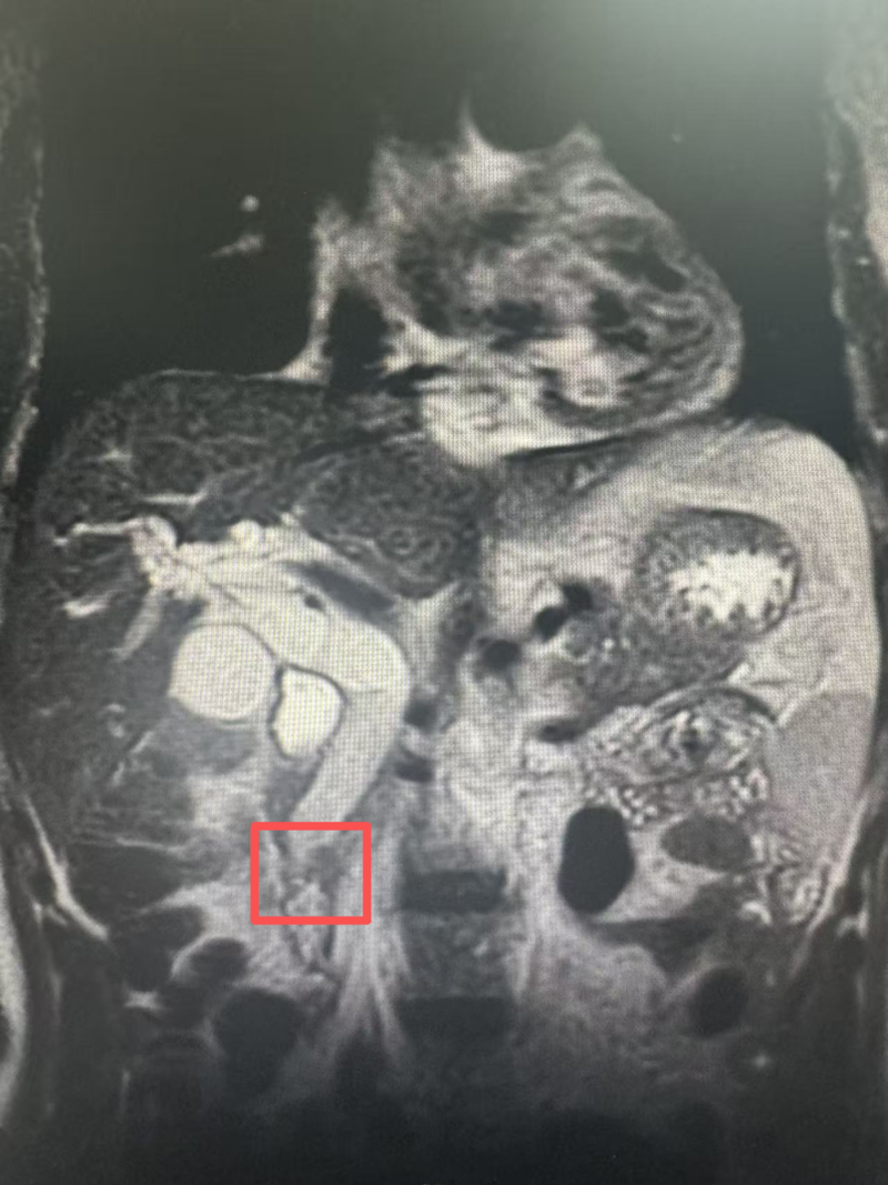 黄疸背后暗藏“隐形杀手”,北京大学人民医院青岛医院多学科协作突破外科手术天花板!