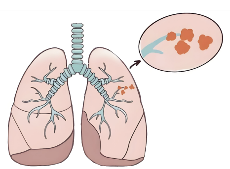 秋冬养肺正当时!济南南郊医院王言森教授提醒:肺结节人群需关注这些信号
