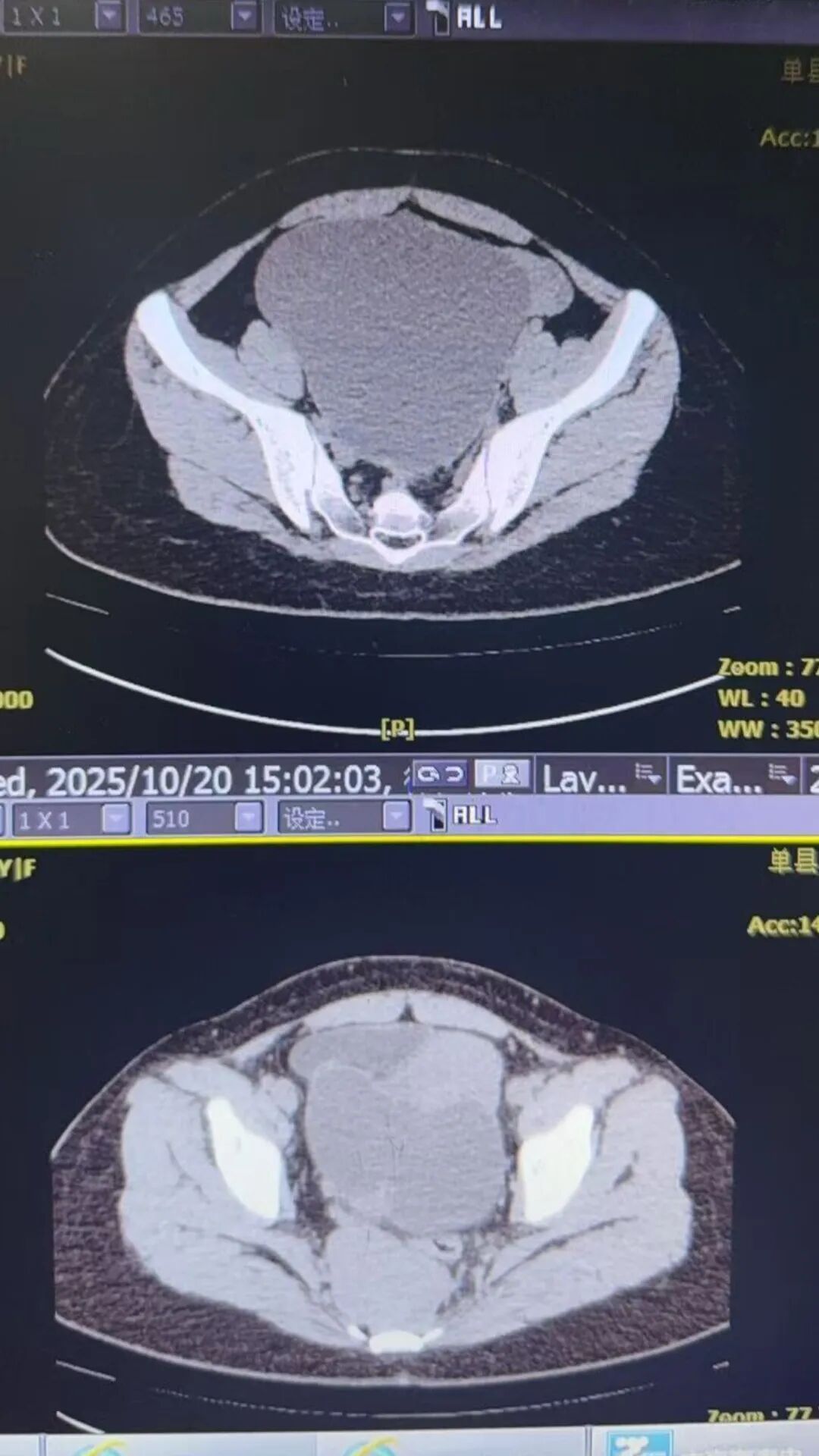 单县中心医院妇科成功完成一例盆腔巨大肿瘤合并骶前肿瘤的高难度手术