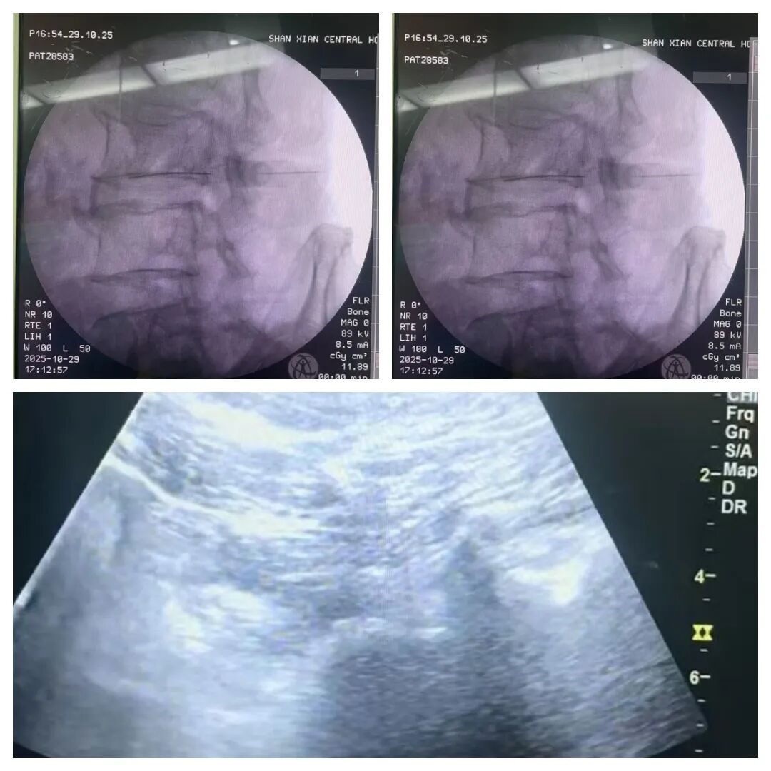 单县中心医院疼痛科开展超声+X线双引导腰交感神经阻滞术,为糖尿病足患者带来“温暖”希望