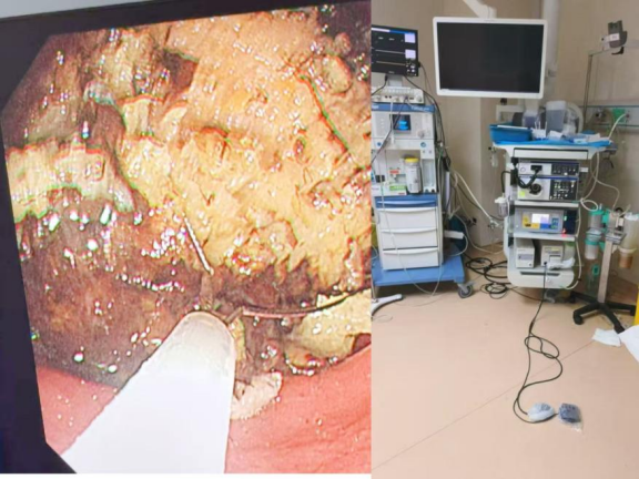 济南南郊医院消化内科任淑红主任提醒:山楂柿子别贪嘴,科学食用护肠胃