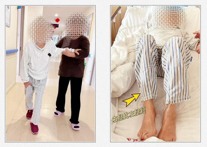 40年病痛折磨终获解脱 济南南郊医院为七旬患者重塑髋关节功能