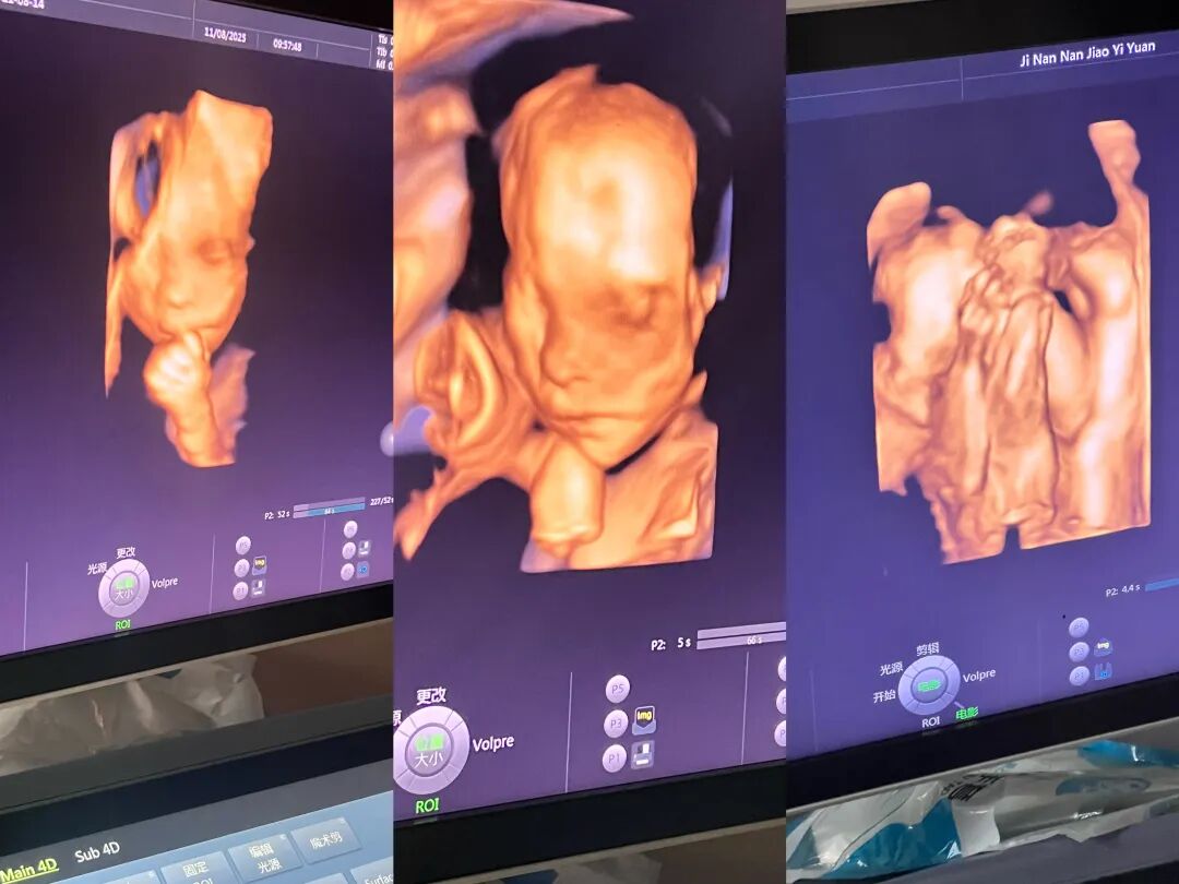 多胎妊娠产检如闯关 济南南郊医院超声科专业团队为母婴安全保驾护航