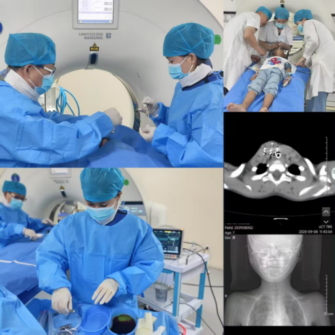 碘125粒子+动脉灌注双管齐下 济南南郊医院微创技术救治罕见儿童甲状腺纤维肉瘤