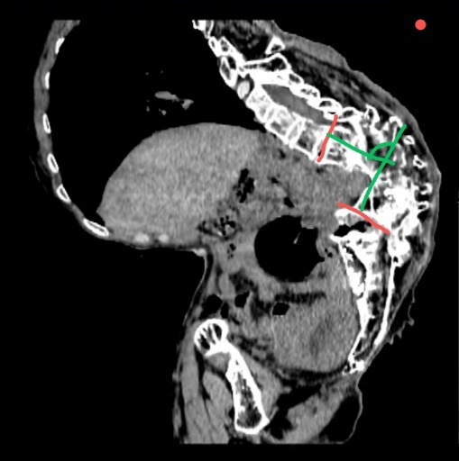 山东第一医科大学附属省立医院成功为合并重度脊柱后凸侧弯畸形的患者实施高难度经腹子宫次全切术