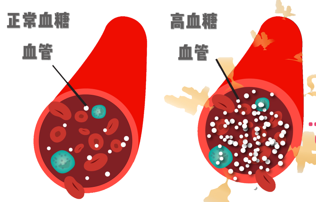 尖峰眼科解答:年轻人得了糖尿病性白内障怎么办?