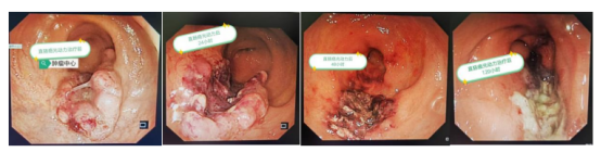 超低位直肠癌保肛新突破 上海一院光动力介入技术提供新路径