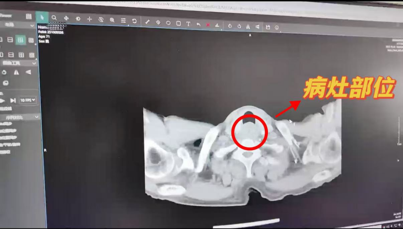 从“滴水难进”到流质饮食 济南南郊医院肿瘤科攻克食管气管双重危机