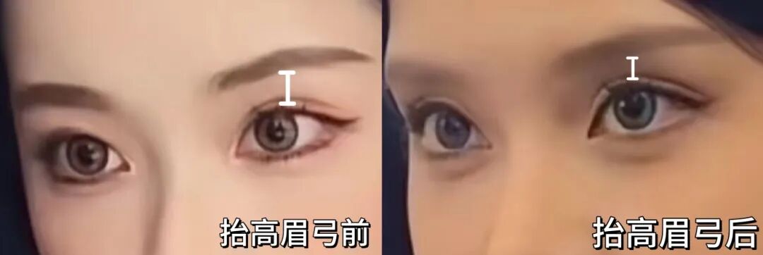 听劝!杏林整形:这4类人,千万别轻易填“高眉弓”!