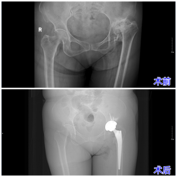 破解数十年髋疾难题,济南南郊医院骨科成功为复杂扁平髋患者实施关节置换术