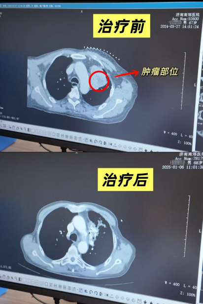 七旬肺癌晚期患者辗转求医无果 南郊医院肿瘤科精准介入治疗让生命重燃希望