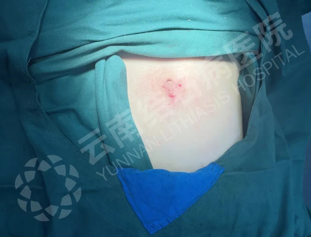 超微创,无疤痕!云南结石病医院取石技术,帮助特殊职业顺利过关