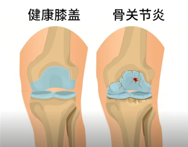 骨关节炎用药科普:硫酸氨基葡萄糖和盐酸氨基葡萄糖有什么区别?