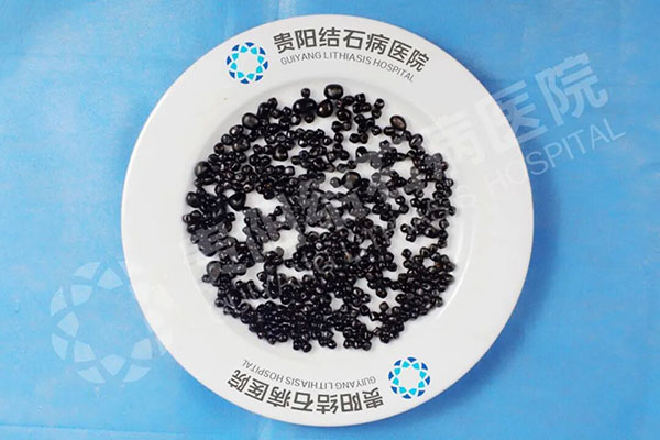 胆囊内惊现388颗结石!四川患者来贵阳结石病医院成功“保胆”