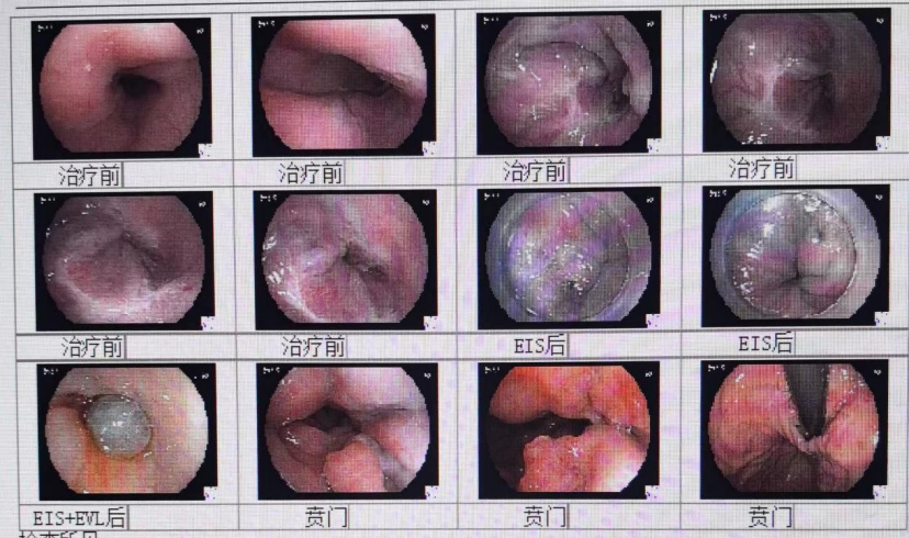 精准诊疗护佑生命 济南南郊医院内镜微创技术救治食管静脉曲张破裂大出血