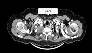 临沂市人民医院成功完成一例复杂颈胸交界处神经源性肿瘤切除术