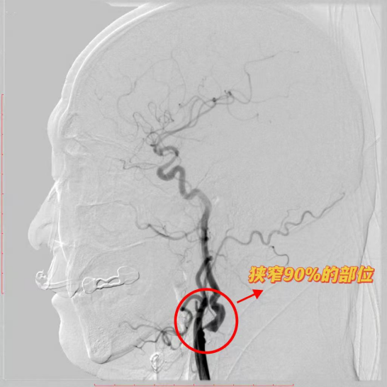 新春开年捷报!济南南郊医院脑科团队接连攻克三例高难度手术