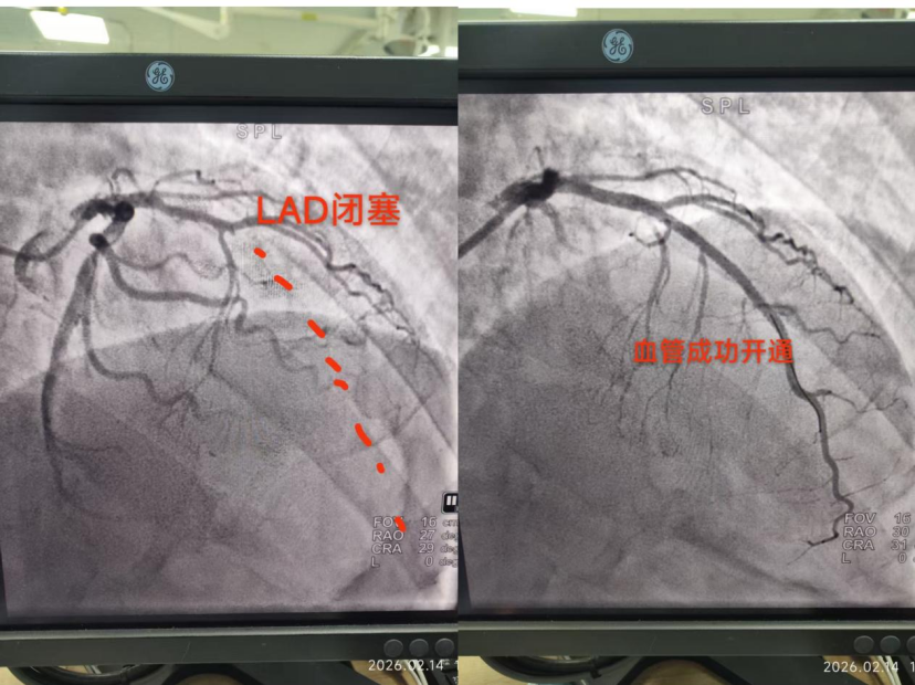 六旬老人突发心梗命悬一线 济南南郊医院绿色通道成功救治