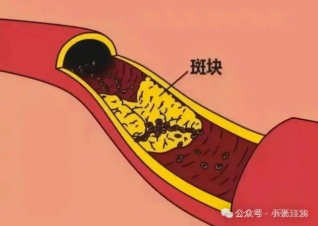 步长精品脑心通胶囊:清除血管“水垢”,守护心脑健康