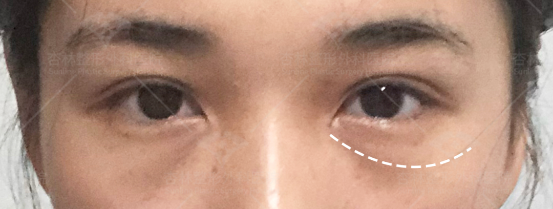 眼周年轻化的4个误区!杏林祛眼袋:不知道这些,你真会踩雷!