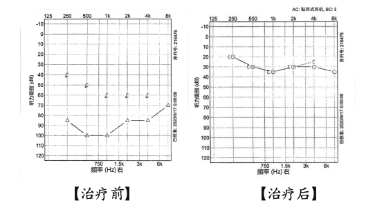一觉醒来耳朵“静音”了?把握72小时黄金抢救期,错过就不可逆!