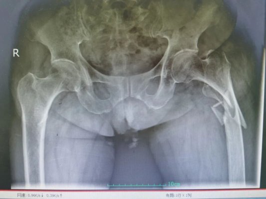 心衰、血栓、贫血……90岁奶奶遇“人生最后一次骨折” ,青岛西海岸第二医院多学科联手闯11重难关护平安