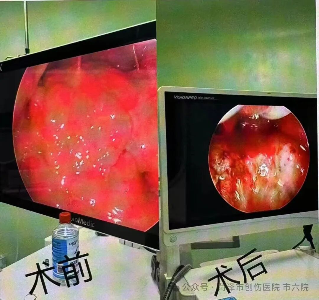 微创除病灶 菏泽市创伤医院(市六院)成功救治6岁过敏性哮喘合并腺样体肥大患儿