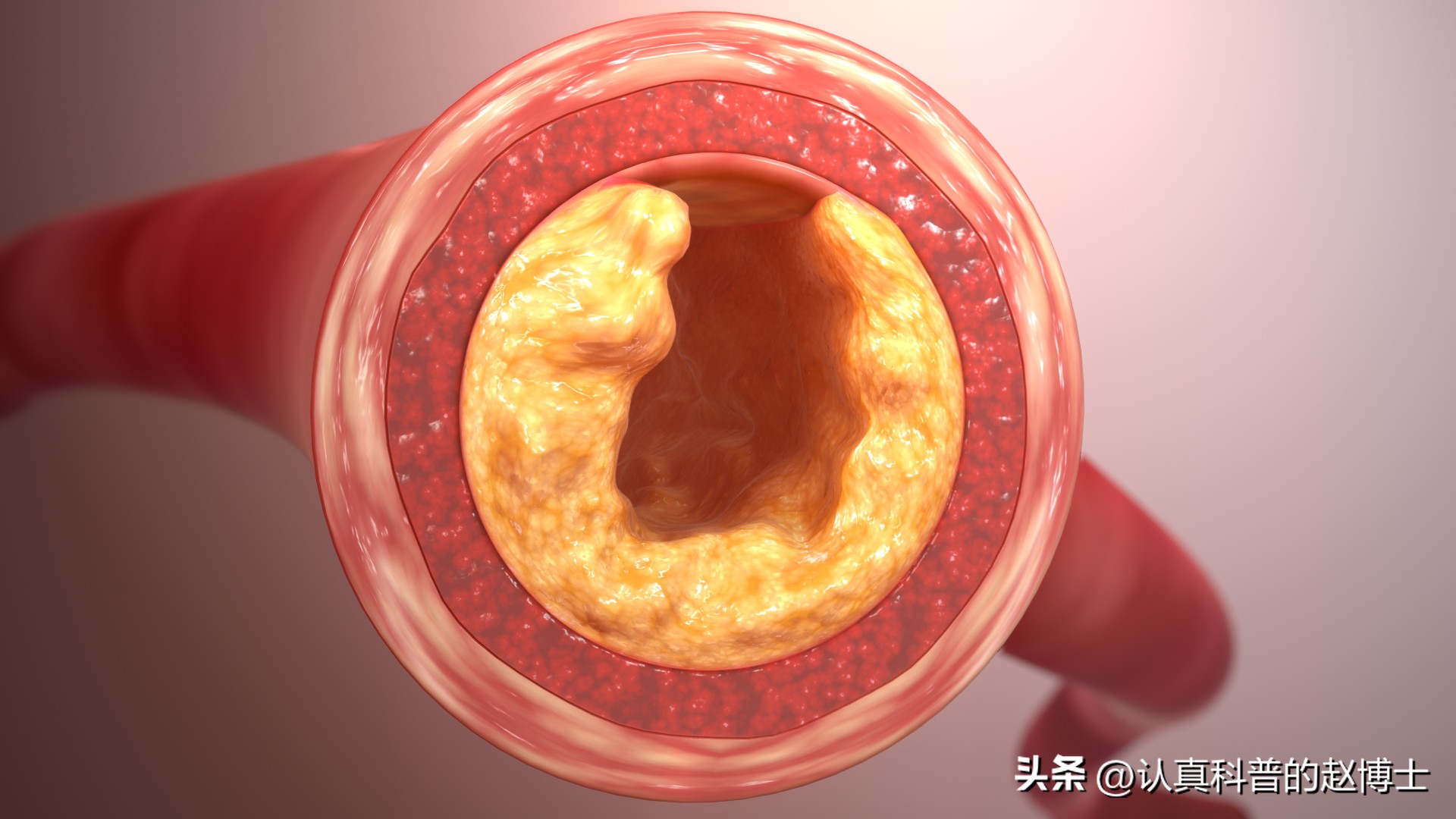 2026斑块治疗重要进展!中药通心络能显著稳定冠脉易损斑块!